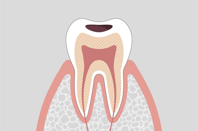 象牙質に達する虫歯