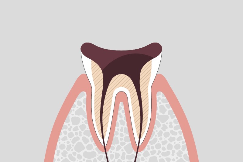 歯の根まで進行した虫歯