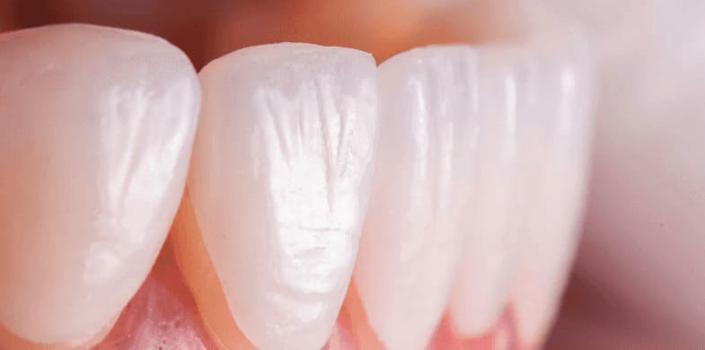 ラミネートべニア（歯の表面に貼る薄いセラミック）