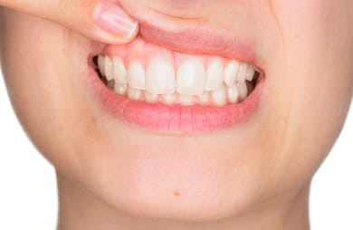 ガムピーリング（歯ぐきの黒ずみを改善）