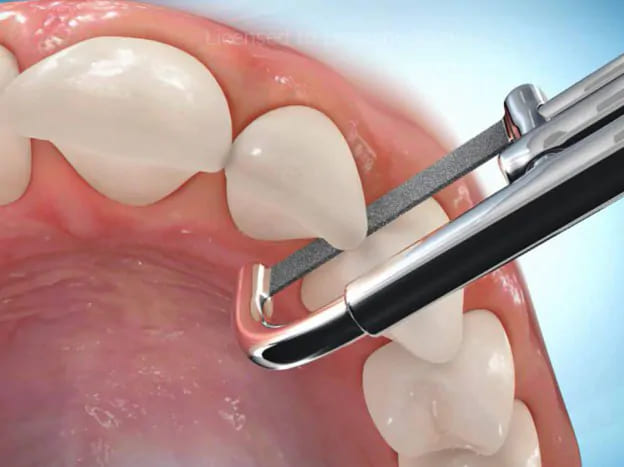 抜歯を避ける「ディスキング」で負担を軽減」