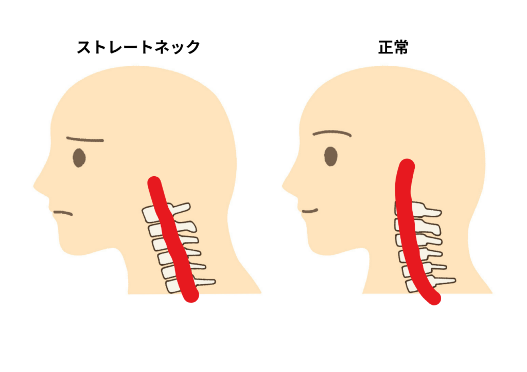 ストレートネックと通常の首の比較